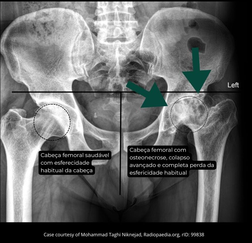 Imagens ilustrações textos (3) Radiografia anteroposterior (AP) da bacia. Nota-se a esfericidade preservada da cabeça femoral à direita, em contraste com o colapso avançado à esquerda.