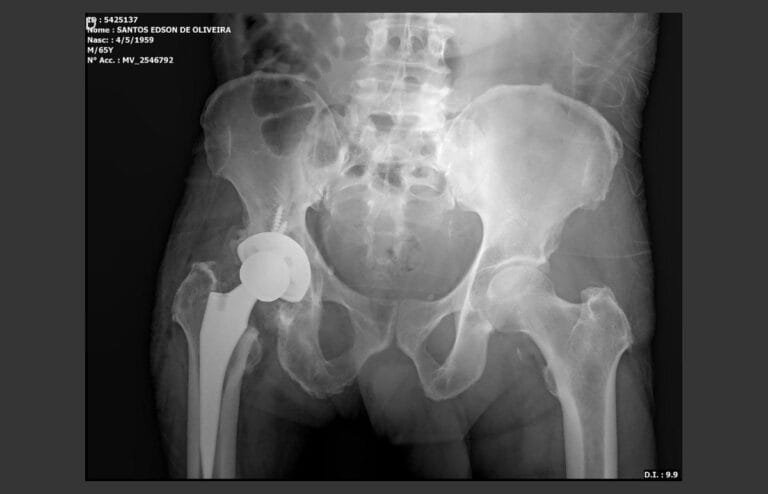 Radiografia de bacia mostrando uma prótese total de quadril implantada ao lado do quadril nativo.