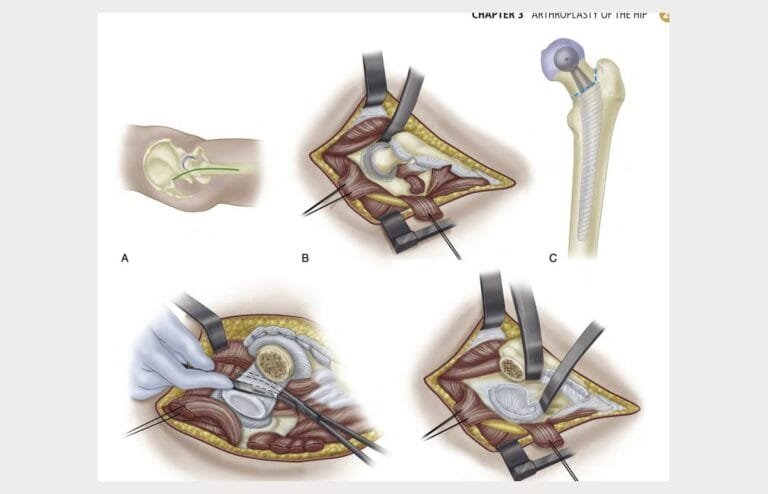 Ilustração das etapas da cirurgia de prótese total do quadril, do preparo do acetábulo ao posicionamento do componente femoral.